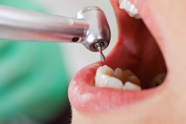 Best Emergency Dental Care for Broken or Chipped Teeth in Russellton, PA